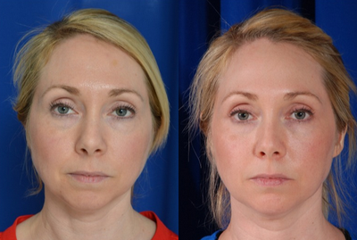35-44 year old woman treated with Voluma - Voluma to cheeks with noticeable improvement at cheek and eyelid junction