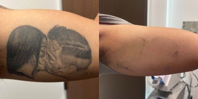 29 year old man treated with PicoWay - A 29-year-old male underwent five PicoWay laser treatments for tattoo removal. The procedure significantly lightened the tattoo, with minimal residual pigment visible. This advanced laser technology effectively targeted ink particles while preserving the surrounding skin, delivering impressive results over the course of treatment.