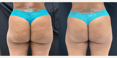 After 2 QWO treatments - While the full results from QWO will not be achieved until 28 days after the final treatment of her series, my patient and I are both thrilled to share the results so far!QWO is the first and only FDA-approved injectable treatment for moderate to severe cellulite on the buttocks of women.  QWO is performed at my office as a series of 3 treatments spaced 21 days apart.