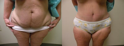 58 year old woman treated with Mommy Makeover - 	58 year old female who had an abdominoplasty (tummy tuck) as well as a mastopexy (breast lift). Has been extremely pleased with the results.