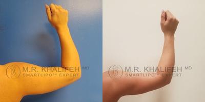 25-34 year old woman treated with Laser Liposuction - Greater definition can be obtained to define the contours of the deltoid, triceps, and the borders of the bicep muscles while doing Arm laser lipo.