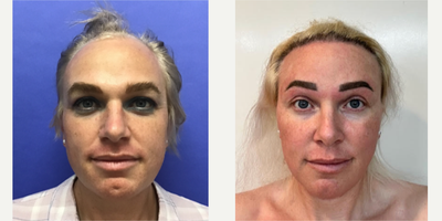 Patient treated with Facial Feminization Surgery, Transgender Facial Feminization Surgery, Septoplasty, Rhinoplasty, Cheek Augme - 25 to 44 year-old female patient is 2 years post-op from Facial Feminization surgery. Her procedures included: Placement of Tissue Expander for Mayer Flap, Forehead Lift and Orbital Bony Contouring, Septorhinoplasty (closed) with Cartilage Grafts and Weirs, Cheek Implants (small), Chin Reduction and Contour, Subnasal Lip Lift with Fat Augmentation to Lips, Medium Facelift, 1cc Voluma, Juvederm, Periorbital TCA Peel, and Mole Removal on Face. Patient is 1 year 5 months post-op from Removal of Tissue Expander and Rotate Flap. Patient is 3 months post-op from Dog Ear and 800 Micrografts to Hairline.
