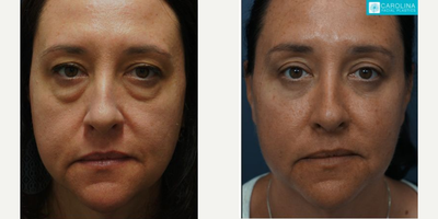 35-44 year old woman treated with Facial - Lower Blepharoplasty and Facial Fat Grafting to Cheeks Before and After Results