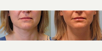 Woman treated with AccuTite - Woman treated with AccuTite