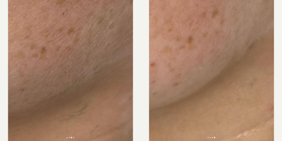 Woman treated with Dermaplaning - Dermaplaning is one of our favorite treatments, that can be added on to other facials or stand alone!Not only is it removing the vellus hair (peach fuzz) but it also exfoliates the first layer of skin to ensure products absorb better!During this treatment you can expect a nice cleaning and hydration mask with massage, to leave you relaxed and glowing!