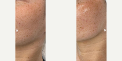 Woman treated with Dermaplaning - Dermaplaning is one of our favorite treatments, that can be added on to other facials or stand alone!Not only is it removing the vellus hair (peach fuzz) but it also exfoliates the first layer of skin to ensure products absorb better!During this treatment you can expect a nice cleaning and hydration mask with massage, to leave you relaxed and glowing!