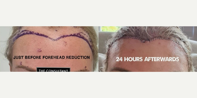 Woman treated with Forehead Reduction - Woman treated with Forehead Reduction andBrow Lift, shown 1 day post op.
