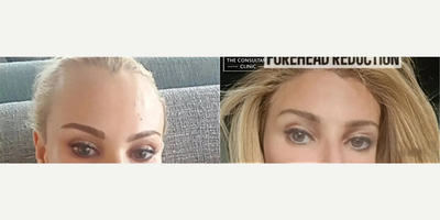 Woman treated with Forehead Reduction - Woman treated with Forehead Reduction andBrow Lift, shown 5 years post op.