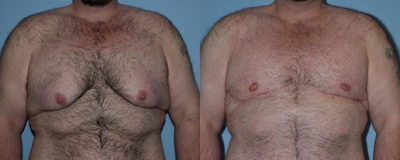 25-34 year old man treated with Gynecomastia Surgery - Male breast reduction with free nipple grafts