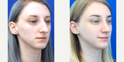 25-34 year old woman treated with Rhinoplasty - Dorsal hump and tension tip are treated via an external approach to reduce the bump on the bridge and sculpt the nasal tip to a more natural appearance. Post 1 year result is shown.
