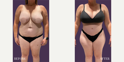 Woman treated with Tummy Tuck - Woman treated with Tummy Tuck, shown 6 months post op. Tummy Tuck reveal!