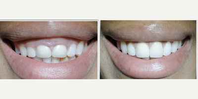 35-44 year old woman treated with Gum Lift - 30 year old femwho was very conscious of her gummy smile and small front teeth. She wanted to change the two unsightly crowns on her two upper front teeth and have a gum lift at the same time. The gum lift procedure is a very straight forward procedure which involves the repositioning of the gums in an upward direction to reveal more tooale th structure. This, in turn, changes the proportions of tooth:gum so that the patient shows more tooth and less gum. The great thing about the gum lift is the immediate gratification post-operatively