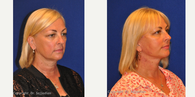 Chin Liposuction - Chin Liposuction