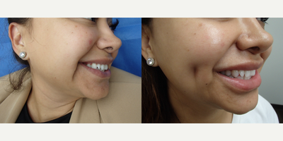 25-34 year old woman treated with Dimple Surgery - Timeless Dimple - Dimple Creation