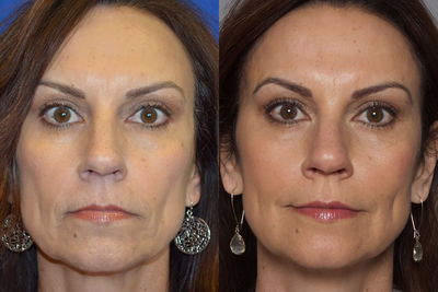 Injectable Fillers - After continued and frequent touch ups with various dermal fillers, patient inquired about a longer lasting alternative to rejuvenate her appearance. Dr. Ho advised Sculptra to stimulate collagen production. Patient received a series of treatments.