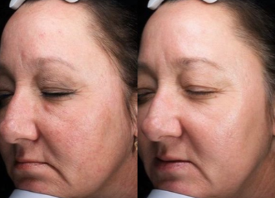 45-54 year old woman treated with ThreeForMe - A series of ThreeForMe treatments were performed on this patient for over all texture improvement.
