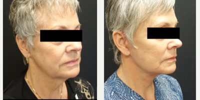 55-64 year old woman treated with Neck Lift - Patient underwent a high lateral SMAS face and neck lift with platysma band plication and facial fat grafting.  The combination of all these techniques give her a dramatic difference in her neck while still maintaining a natural appearance to the face overall.  The fat grafting restores the volume that patients lose over time as they age. The combination of the fat transfer and facelift give patients a more natural and youthful appearance.