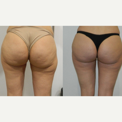 45-54 year old woman treated with Carboxytherapy - 40 year old woman after 12 sessions of carboxytherapy