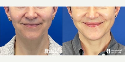 45-54 year old woman treated with Dermal Fillers, Juvederm, Restylane, Sculptra, Radiesse, Botox, Skin Tightening - The patient is a 53-year-old female who had concerns about facial aging, specifically volume loss and skin quality. To address these concerns, Dr. Chiang designed a comprehensive, multi-year layered treatment plan. Over three years, the approach combined dermal fillers (Juvderm, RHA 2, and Restylane) to restore structure to the under-eyes, cheeks, nasolabial folds, lips, chin, and jawline, alongside biostimulators (Sculptra and Radiesse) to enhance the temples and mid-face. To further refine her contours, Botox was targeted to the chin, masseters, and platysmal bands, while full-face and neck Sofwave treatments provided non-surgical skin tightening. The results shown are from 3 years after beginning this personalized treatment plan.