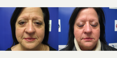 Woman treated with Botox - Woman treated with Botox.