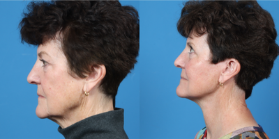 65-74 year old woman treated with Facelift, Earlobe Repair, diVa Vaginal Laser - SMAS Facelift. Facial fat-grafting. Platysmaplasty. Bilateral upper eyelid blepharoplasty. Peri oral CO2 laser resurfacing.Fat graft set, CO2 laser