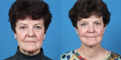 65-74 year old woman treated with Facelift, Earlobe Repair, diVa Vaginal Laser - SMAS Facelift. Facial fat-grafting. Platysmaplasty. Bilateral upper eyelid blepharoplasty. Peri oral CO2 laser resurfacing.Fat graft set, CO2 laser