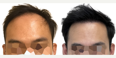 39 year old man treated with FUE Hair Transplant, Minoxidil and Low-Level Laser Therapy (BIOLIGHT Laser Cap) - This is a 39-year-old male who came to us with a history of hair loss spanning more than 10 years, starting in his late 20s. At the time of his consultation, he was not on any medications or taking any steps to slow or stop his hair loss. There was a strong family history of hair loss in his father and maternal grandfather. What bothered him most was the thinning in the frontal scalp as well as the appearance of a very deep widows peak on both sides of the hairline. You can see in the frontal view that, with the extent of thinning, you can see almost as far back as the mid-scalp. He was seeking a more youthful hairline with added density in the frontal scalp. This was his first surgery. He had a 1500 graft FUE to rebuild the hairline and add density behind it in the frontal scalp. Being close to 40 years old he wanted the resulting shape and density to appear as natural as possible. We used an irregularly irregular scalloped design to mimic the natural appearance of a hairline, focussing on density in the nearly empty areas just behind the hairline. Additional density was placed behind that. At the same time, he was started on a preventive regimen of high-strength minoxidil and the BIOLIGHT laser cap to prevent any more ongoing hair loss. He returned to us 11 months after his surgery with amazing results and hes very happy! The widows peak has been softened and weve been able to maintain natural, masculine corners in the fronto-temporal angles (where the front hairline meets the side hairline). There is enough density in the frontal scalp that you cant see through it to the mid-scalp behind anymore. The donor area looks amazing and you cant tell that any grafts have been extracted from that area. In fact, nobody who just met him would be able to tell that hes had any hair transplant surgery at all! The supplementary therapies (minoxidil and laser cap) have worked really well so far to help him keep the hair he still has, and theres been no progression of his hair loss in other areas. We discussed a long-term maintenance strategy and hes going to continue with his high-strength minoxidil and BIOLIHT laser cap indefinitely. If he ever decides to seek just a little added density in the crown, we discussed the possibility of starting platelet-rich plasma (PRP).
