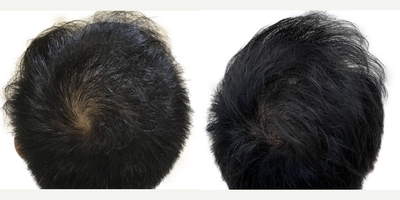 39 year old man treated with FUE Hair Transplant, Minoxidil and Low-Level Laser Therapy (BIOLIGHT Laser Cap) - This is a 39-year-old male who came to us with a history of hair loss spanning more than 10 years, starting in his late 20s. At the time of his consultation, he was not on any medications or taking any steps to slow or stop his hair loss. There was a strong family history of hair loss in his father and maternal grandfather. What bothered him most was the thinning in the frontal scalp as well as the appearance of a very deep widows peak on both sides of the hairline. You can see in the frontal view that, with the extent of thinning, you can see almost as far back as the mid-scalp. He was seeking a more youthful hairline with added density in the frontal scalp. This was his first surgery. He had a 1500 graft FUE to rebuild the hairline and add density behind it in the frontal scalp. Being close to 40 years old he wanted the resulting shape and density to appear as natural as possible. We used an irregularly irregular scalloped design to mimic the natural appearance of a hairline, focussing on density in the nearly empty areas just behind the hairline. Additional density was placed behind that. At the same time, he was started on a preventive regimen of high-strength minoxidil and the BIOLIGHT laser cap to prevent any more ongoing hair loss. He returned to us 11 months after his surgery with amazing results and hes very happy! The widows peak has been softened and weve been able to maintain natural, masculine corners in the fronto-temporal angles (where the front hairline meets the side hairline). There is enough density in the frontal scalp that you cant see through it to the mid-scalp behind anymore. The donor area looks amazing and you cant tell that any grafts have been extracted from that area. In fact, nobody who just met him would be able to tell that hes had any hair transplant surgery at all! The supplementary therapies (minoxidil and laser cap) have worked really well so far to help him keep the hair he still has, and theres been no progression of his hair loss in other areas. We discussed a long-term maintenance strategy and hes going to continue with his high-strength minoxidil and BIOLIHT laser cap indefinitely. If he ever decides to seek just a little added density in the crown, we discussed the possibility of starting platelet-rich plasma (PRP).