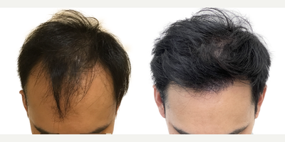 39 year old man treated with FUE Hair Transplant, Minoxidil and Low-Level Laser Therapy (BIOLIGHT Laser Cap) - This is a 39-year-old male who came to us with a history of hair loss spanning more than 10 years, starting in his late 20s. At the time of his consultation, he was not on any medications or taking any steps to slow or stop his hair loss. There was a strong family history of hair loss in his father and maternal grandfather. What bothered him most was the thinning in the frontal scalp as well as the appearance of a very deep widows peak on both sides of the hairline. You can see in the frontal view that, with the extent of thinning, you can see almost as far back as the mid-scalp. He was seeking a more youthful hairline with added density in the frontal scalp. This was his first surgery. He had a 1500 graft FUE to rebuild the hairline and add density behind it in the frontal scalp. Being close to 40 years old he wanted the resulting shape and density to appear as natural as possible. We used an irregularly irregular scalloped design to mimic the natural appearance of a hairline, focussing on density in the nearly empty areas just behind the hairline. Additional density was placed behind that. At the same time, he was started on a preventive regimen of high-strength minoxidil and the BIOLIGHT laser cap to prevent any more ongoing hair loss. He returned to us 11 months after his surgery with amazing results and hes very happy! The widows peak has been softened and weve been able to maintain natural, masculine corners in the fronto-temporal angles (where the front hairline meets the side hairline). There is enough density in the frontal scalp that you cant see through it to the mid-scalp behind anymore. The donor area looks amazing and you cant tell that any grafts have been extracted from that area. In fact, nobody who just met him would be able to tell that hes had any hair transplant surgery at all! The supplementary therapies (minoxidil and laser cap) have worked really well so far to help him keep the hair he still has, and theres been no progression of his hair loss in other areas. We discussed a long-term maintenance strategy and hes going to continue with his high-strength minoxidil and BIOLIHT laser cap indefinitely. If he ever decides to seek just a little added density in the crown, we discussed the possibility of starting platelet-rich plasma (PRP).