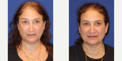35-44 year old woman treated with Emface - Emface