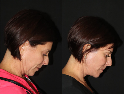 45-54 year old woman treated with Facelift, Revision Neck Lift, CO2 Laser, PRP - Proceduresperformed included:1. Very conservative neck liposculpting and excision of old scar tissue from under the chin to smooth out and repair the irregularities that occurred after her previous procedure by another surgeon2. Advanced Multilayer SMAS Facelift technique to lift her cheeks, tighten her jawline, remove her old scars and excess skin in her face/neck3. CO2 laser skin resurfacing and platelet rich plasma ( PRP ) to tighten and improve her skin quality
