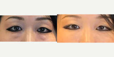 45-54 year old woman treated with Belotero - My 53 year old patient 2 weeks post Belotero and Dysport in the under eye area, as well as Dysport in the glabella lines and forehead and 1 syringe of Restylane Lyft in her cheeks. She also had a HydraFacial to imrpove the texture and tone and add hydration into the skin.