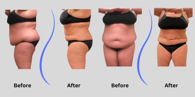44 year old woman treated with Funsculpting Lipo 360 - 2 Sessions of Funsculpting HD Lipo360 to achieve a 4 inch reduction in waistline.