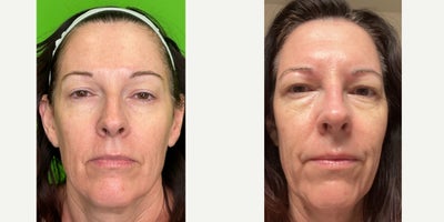 55-64 year old woman treated with BroadBand Light (BBL), Fractional Laser - Patient had and BBL/Nano Peel Laser