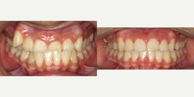 35-44 year old woman treated with Damon Braces - The bite was created after wearing an ill-fitting snoring appliances. With Damon braces we were able to correct this bite in 7 months with the aid of Acceldent. Calgary orthodontist at Impressions Orthodontics.