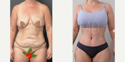 Woman treated with Tummy Tuck, Lipo 360 - Woman treated with Tummy Tuck, Lipo 360