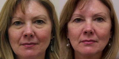 Woman treated with Restylane - Injectable Fillers to under eyes