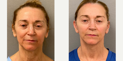 65-74 year old woman treated with Facelift, Neck Lift, SMAS Facelift - 68 yo s/p facelift, neck lift, performed under local anesthesia with sedation in our on site AAAA certified operating suite