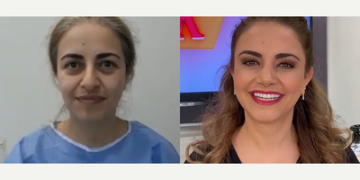 47 year old woman treated with Cheek Augmentation - 47 year old woman treated with Cheek Augmentation through facial fat transferas well as Lower Facelift through Deep Plane Facelift, Eyelid Surgery and Rhinoplasty, shown 6 months post op. Pre-op, she felt ugly due to her husband who kept telling her so.