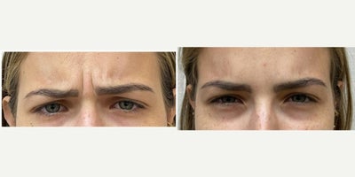 25-34 year old woman treated with Botox, Dysport - Treated by Aubrey H.