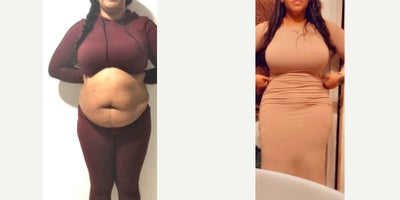 25-34 year old woman treated with Tummy Tuck, Liposuction, Brazilian Butt Lift - Tummy Tuck, Liposuction, Brazilian Butt Lift