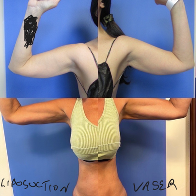 45-54 year old woman treated with Vaser Liposuction - Vaser ultrasound PAL liposuction only  (no arm lift, no skin excision, no scar)