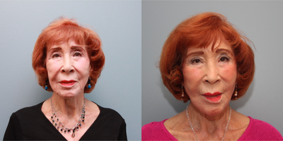 83 year old woman treated with the LiteLift which is similar to the Lifestyle Lift - Dr. Nichter performed his exclusive LiteLift facelift procedure which is similar to the LifeStyle Lift no longer available. The procedure uses shorter incisions, has less downtime, and can be performed under local anesthesia. This particular patient also had a platysmaplasty to tighten her neck bands and fat grafting to her pre-jowls.