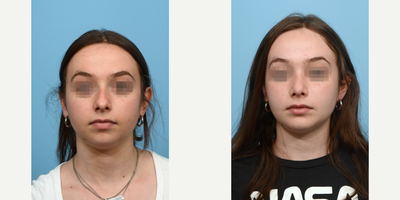18-24 year old woman treated with Chin Surgery - This patient underwent a combination rhinoplasty and chin augmentation surgery to improve her facial symmetry. 8 weeks post-op, she's thrilled with the outcome.