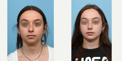 18-24 year old woman treated with Septoplasty - Often times, Dr. Wise recommends a chin implant to go with rhinoplasty to bring proper facial harmony and balance. Such was the case for this 19-year-old patient who absolutely loves her new look.