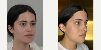 18-24 year old woman treated with V Line Surgery, Forehead Reduction - .