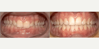 17 or under year old man treated with Lingual Braces - Lingual Braces Treatment