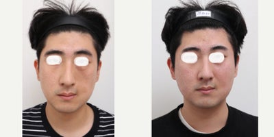 25-34 year old man treated with Nonsurgical Facelift - Chief Complain: Face assymetry, LT cheek dent Treatment Plan: 3 session of facial fat transfer with PRP Outcome: Smooth face line, less visible assymentry, balanced face shape