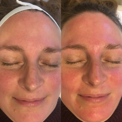 Dermaplaning treatment on 47 year old woman with rosacea - Dermaplane perfomed on this woman with rosacea, immediate hydration and glow afterwords