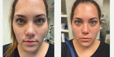 25-34 year old woman treated with Microdermabrasion - Microdermabrasion is a cosmetic procedure that exfoliates the skin to gently remove the top, damaged layer. It helps reduce the look of these blemishes and rejuvenate the healthy glow of your skin.